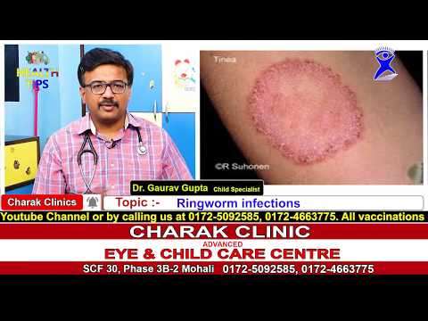 Video: 3 Ways to Treat Ringworm Infections in Children
