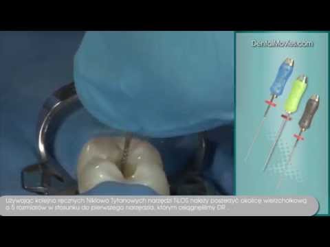 Wideo: Jak pozbyć się luk w zębach: 14 kroków (ze zdjęciami)