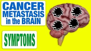 Cancer Metastasis in the Brain - All Symptoms