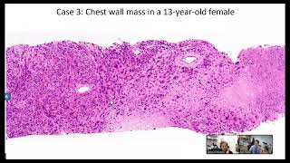 4 newly described soft tissue neoplasms -Interview with David Papke, MD from Harvard Medical School screenshot 1