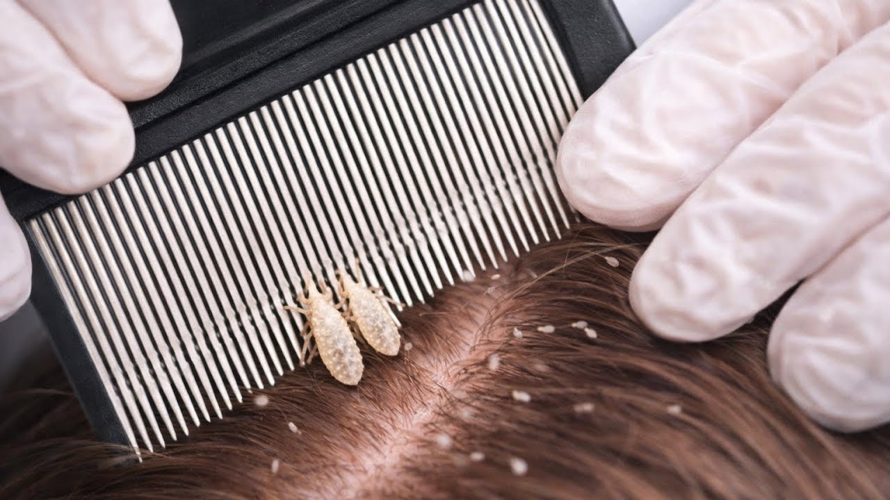 ASMR: проверка на вши у школьной медсестры 💆‍♀️ Уютный и профессиональный осмотр кожи головы | Ро...