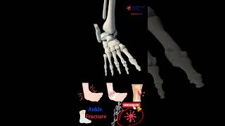 Ankle Injury - Ankle Fracture Animated - Broken Ankles