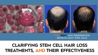 What You Need to Know About Stem Cell Hair Restoration, and the Treatments that Work