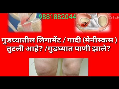 गुडघ्यातील लिगामेंट तुटली ligament tear/गादी फाटली Meniscus tear यासाठी यशस्वी आयुर्वेदिक उपचार..