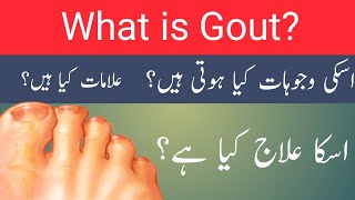 Gout Causes, Symptoms and Treatment in Urdu/Hindi | What is Gout | Gout Causes and Treatment