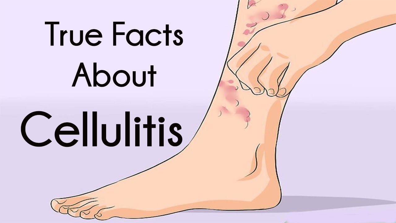 True Facts About Cellulitis Youtube