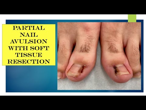 Total Nail Avulsion – Perform Podiatry