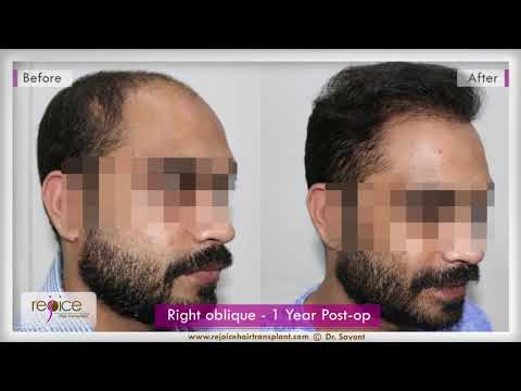 Hair Transplant