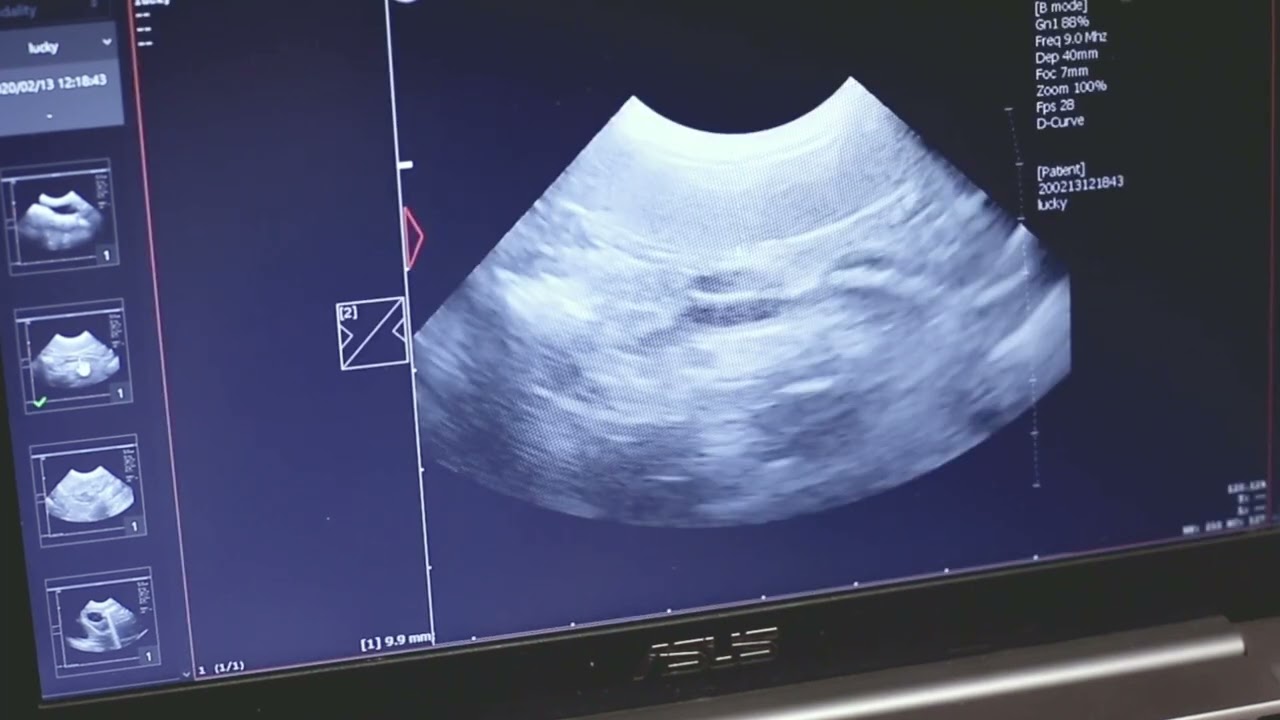 Аппарат УЗИ Med-Mos EMP-3000 (высокого класса) с 5 датчиками