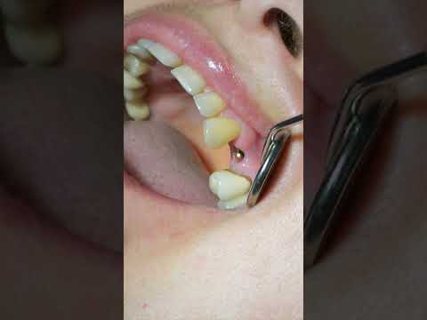 Протезирование зубов на имплантах – установка трансфера