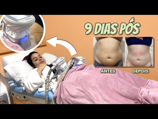 Projeto Verão com Hidrolipoclasia (Lipo Sem Cortes) Em Regiã - Vila matilde  - Vila matilde