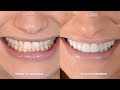 Cosmetic dentist toronto   how many appointments do you need for veneers  porcelain veneer case