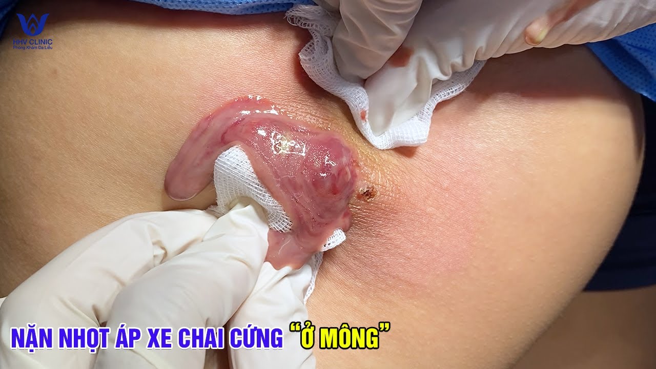 Mụn nhọt ở mông sưng to, nhìn mà thốn luôn - Làm sạch ổ mủ, ngừa thâm sẹo.