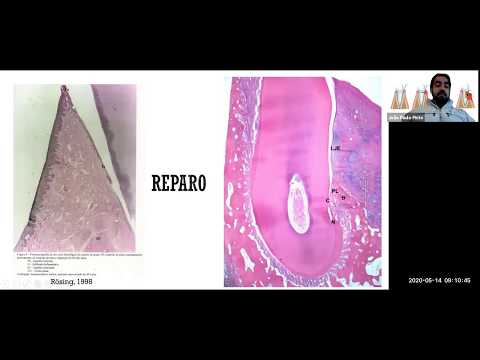 Vídeo: Reparo De Defeitos ósseos Periodontais Humanos Por Células-tronco De Enxerto Autólogo Derivadas De Tecidos Inflamatórios Da Polpa Dentária