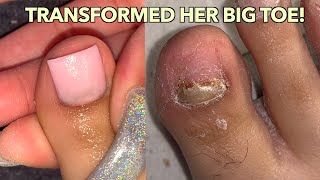 BIG TOENAIL TRANSFORMATION!| ACRYLIC BIG TOENAIL