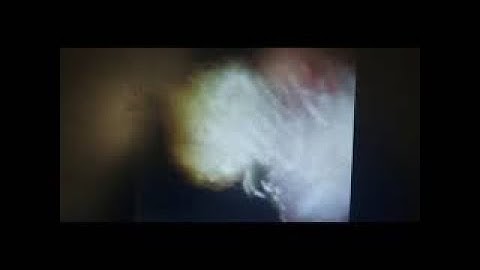ERCP Spyglass Video