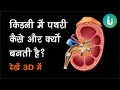             3d   kidney stone treatment in hindi