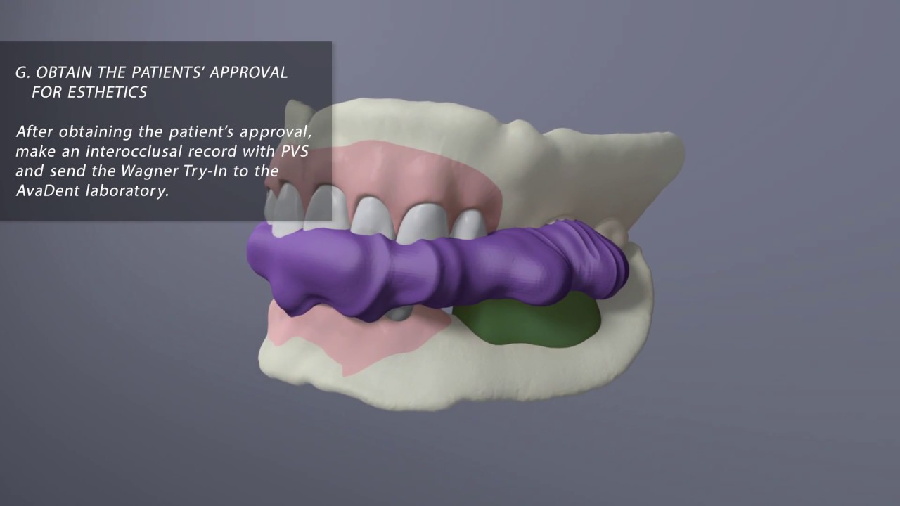 AvaDent Wagner EZ Fit Protocol - 3, 30-Minute Appointments - 2