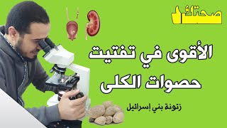 الأقوى في تفتيت حصوات الكلى | زتونة بني إسرائيل