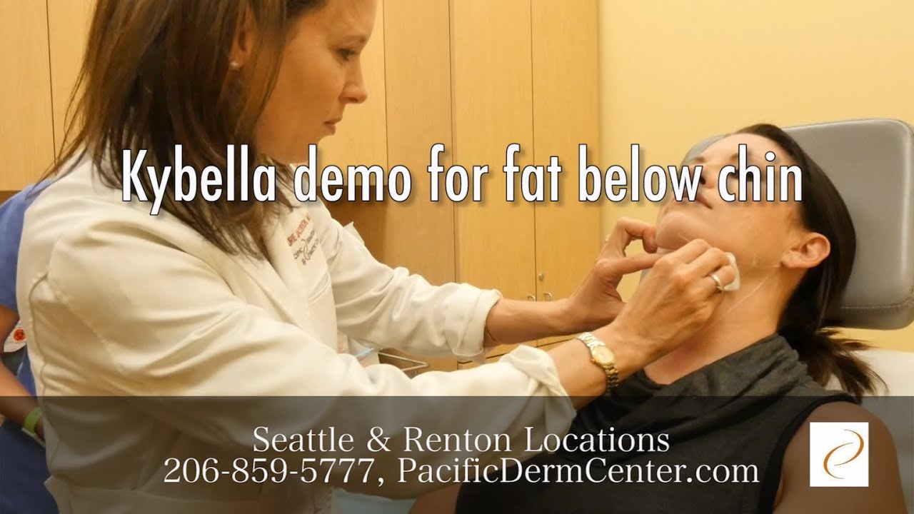 Kybella Demo in 1 minute Fat Removal for Double Chin. Seattle
