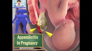 Acute Appendicitis in Pregnancy ,Symptomes ,Signs ,Diagnosis Investigations,Treatment,Complications