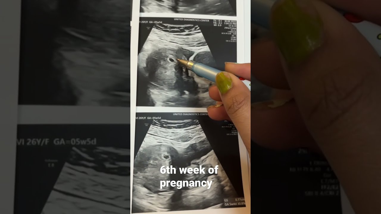  Gestationalsac6thweek Ofpregnancy Pregnancyusg Drphysicalgyan