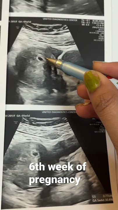 #gestationalsac6thweek ofpregnancy#pregnancyusg #drphysicalgyan#
