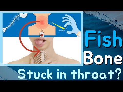 Video: Hoe om 'n visbeen uit u keel te kry: 9 stappe (met foto's)