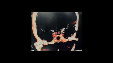 Clipping of a Ruptured Posterior Communicating Artery Aneurysm. #igmcshimla #aneurysm