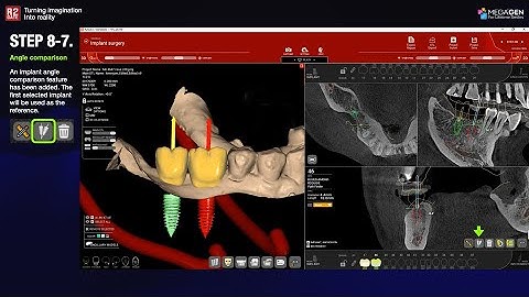 [EN] R2GATE Stand Alone update: Step. 8-7 Implant angle comparison