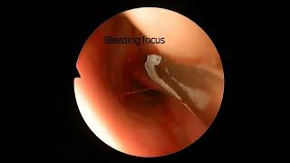 Endoscopic cauterization for posterior epistaxis