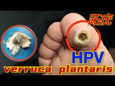 HPV，verruca plantaris足底跖疣