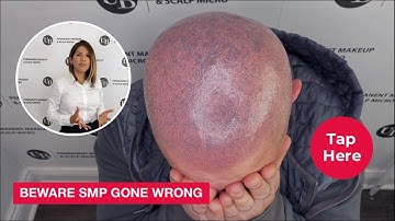 "BEWARE SMP GONE WRONG"  - How to correct Scalp Tattoo by Unyozi Beauty