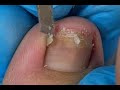 Best Toenail repair skill