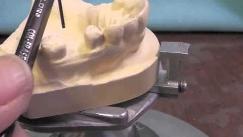 R P D Design - Ken Class II Max Cast #4 Part B