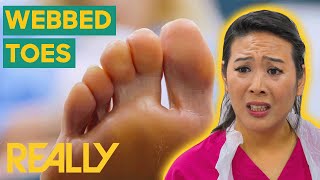 Treating A Patient That Has Suffered From Webbed Toes For 65 Years! | Brand New Series