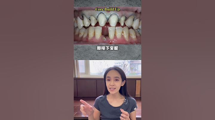 遇到這樣的醫師請收藏到口袋名單！我沒看過那麼自然的陶瓷貼片#假牙 - 天天要聞