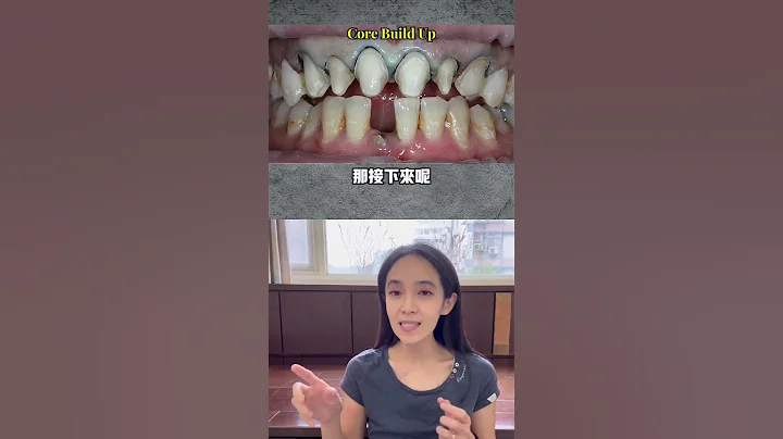 遇到這樣的醫師請收藏到口袋名單！我沒看過那麼自然的陶瓷貼片#假牙 - 天天要聞