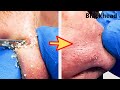 【角栓除去】鼻からドバっと!大量のニキビを芯出しするのって気持ちいい/Blackhead Removal Show