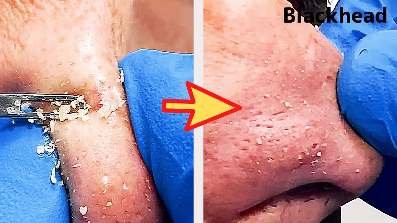 【角栓除去】鼻からドバっと!大量のニキビを芯出しするのって気持ちいい/Blackhead Removal Show
