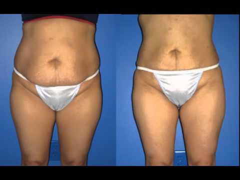 Dr Hall Lipo Rebecca before and after