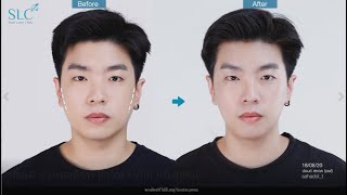 ปรับรูปหน้าให้ หล่อ เรียว แบบคุณปอนด์ด้วย Botox+Vfat