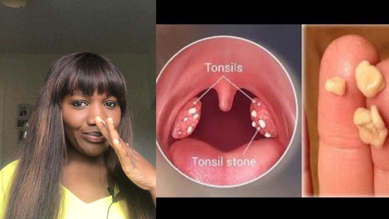 SOLUTION TO PERMANENT TONSIL STONES REMOVAL || STRUGGLING WITH BAD BREATH? WATCH THIS..#