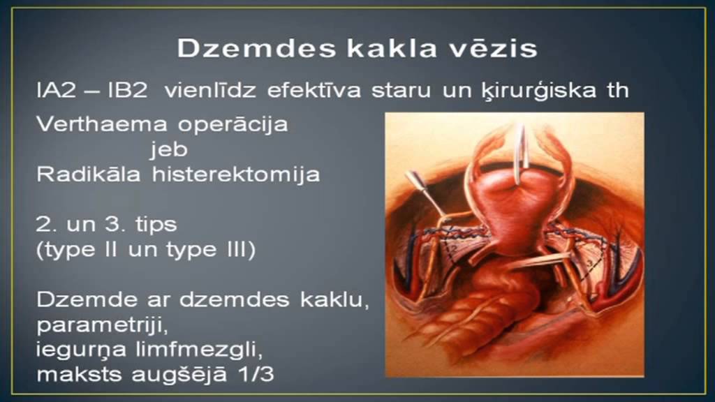 Ginekologs Ronalds Mačuks par dzemdes kakla vēža diagnostiku un ārstēšanu