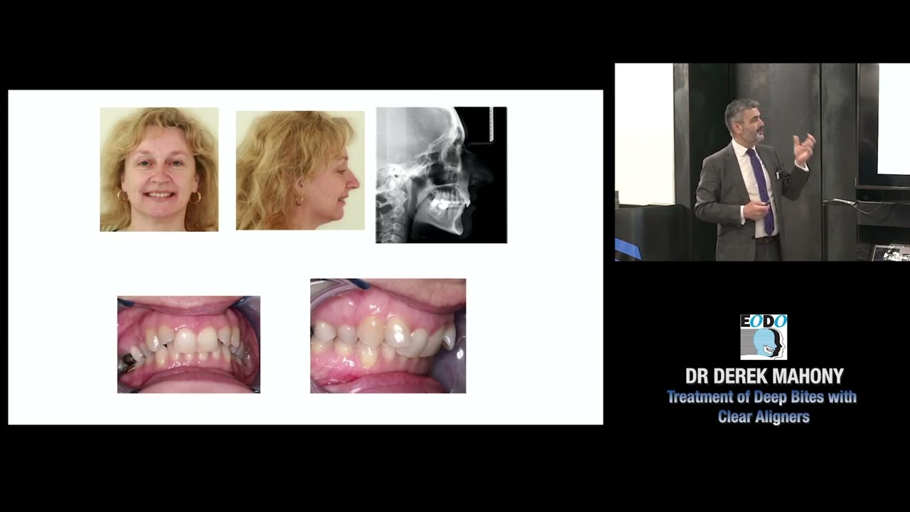 Deep-bite correction with Clear Aligner lecture with Dr Derek Mahony