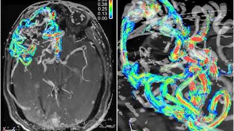 Advances and Innovations in Brain Arteriovenous Malformations Surgery Video 2