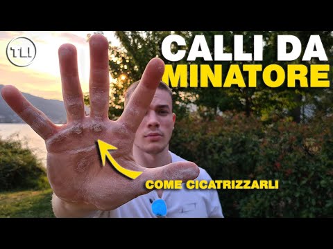 Video: Come Rimuovere i Calli dalle Dita dei Piedi: 12 Passaggi (Illustrato)