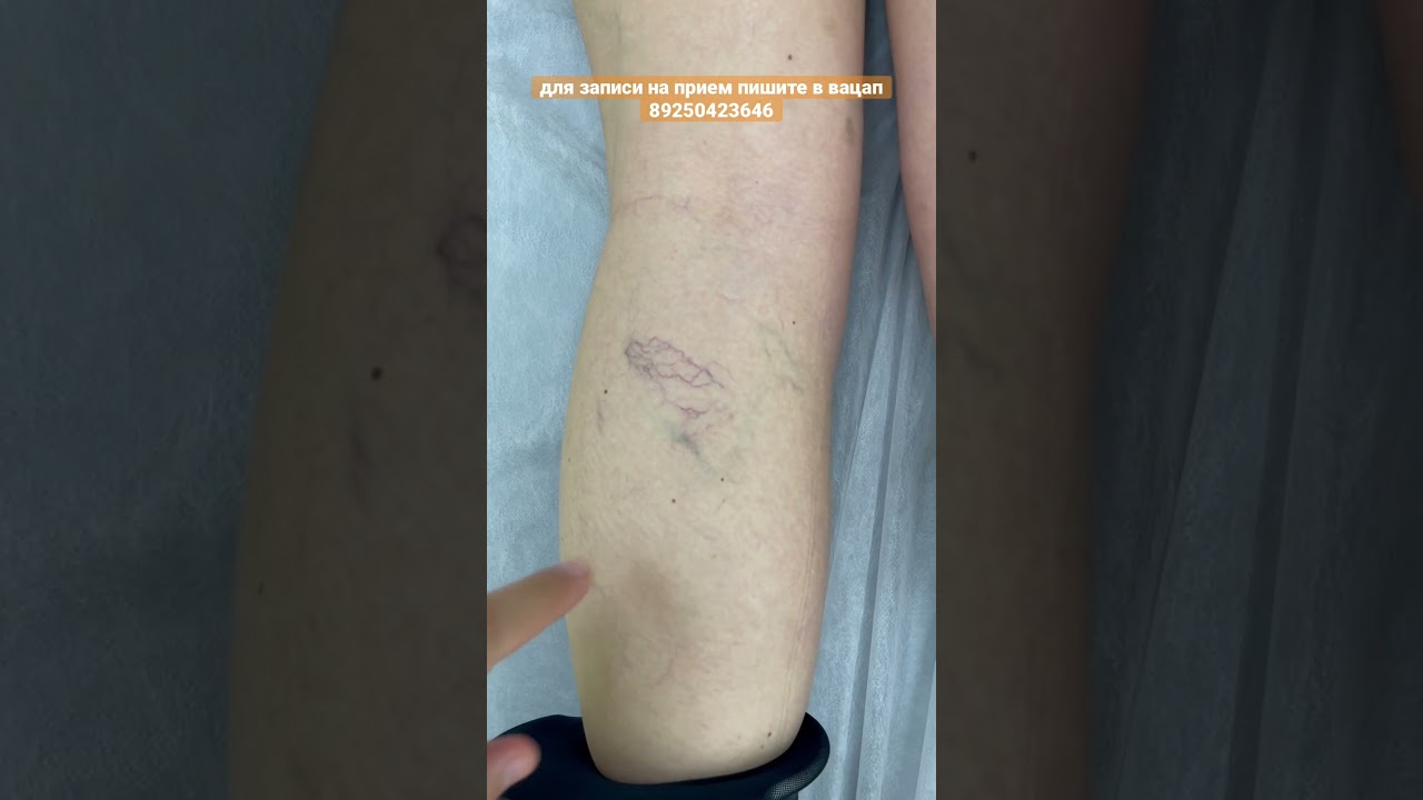 Сосудистая сетка. Склеротерапия. Удаление сосудистой сетки. 