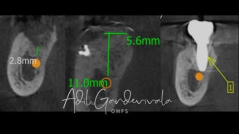 Vertical Augmentation Posterior Mandible- The 10 Commandements