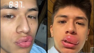Sengatan Tawon Di Bibir Bocah Malang Sebabkan Bengkak Besar | Apa Yang Terjadi Saat Tawon Menyengat Bibir Anda
